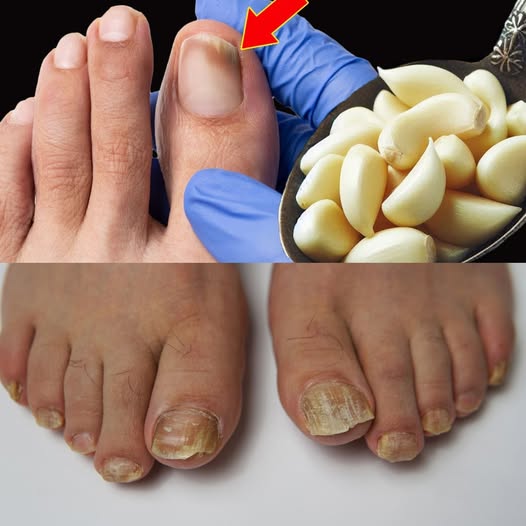 Tea Tree Oil and Ginger for Nail Fungus: A Simple Natural Remedy